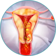 Endometrial Cancer