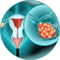 Ovarian Cancer