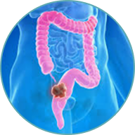 Colon & Rectal Cancer